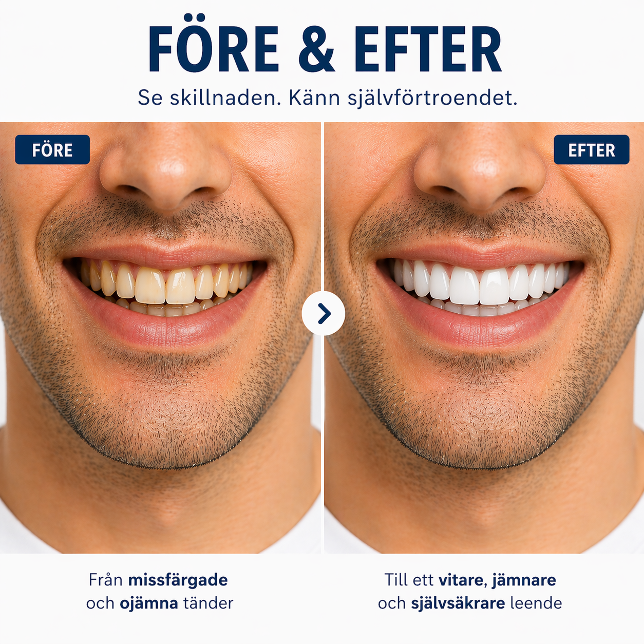 Nordelle® Cosmetic Dentures
